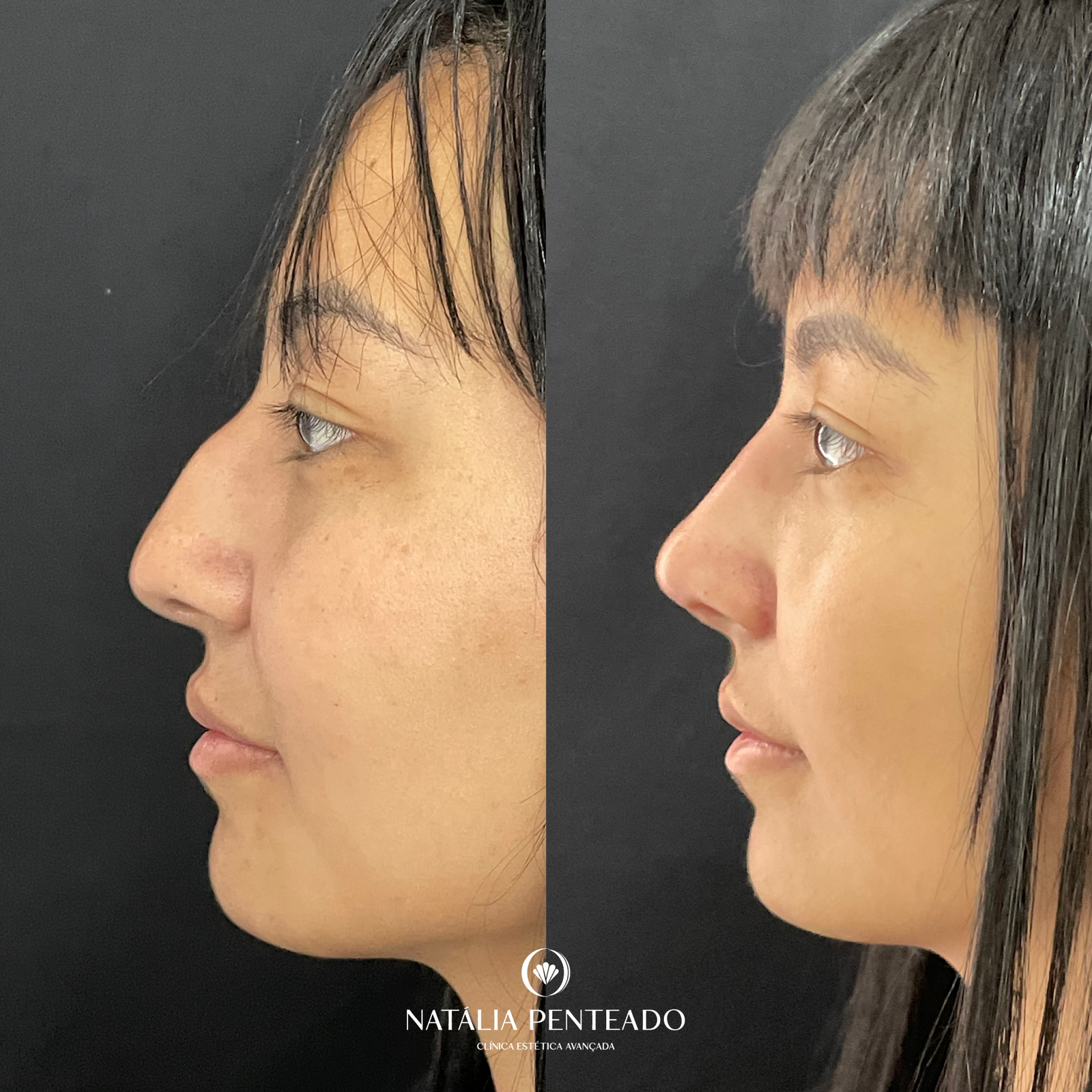 Antes x Depois