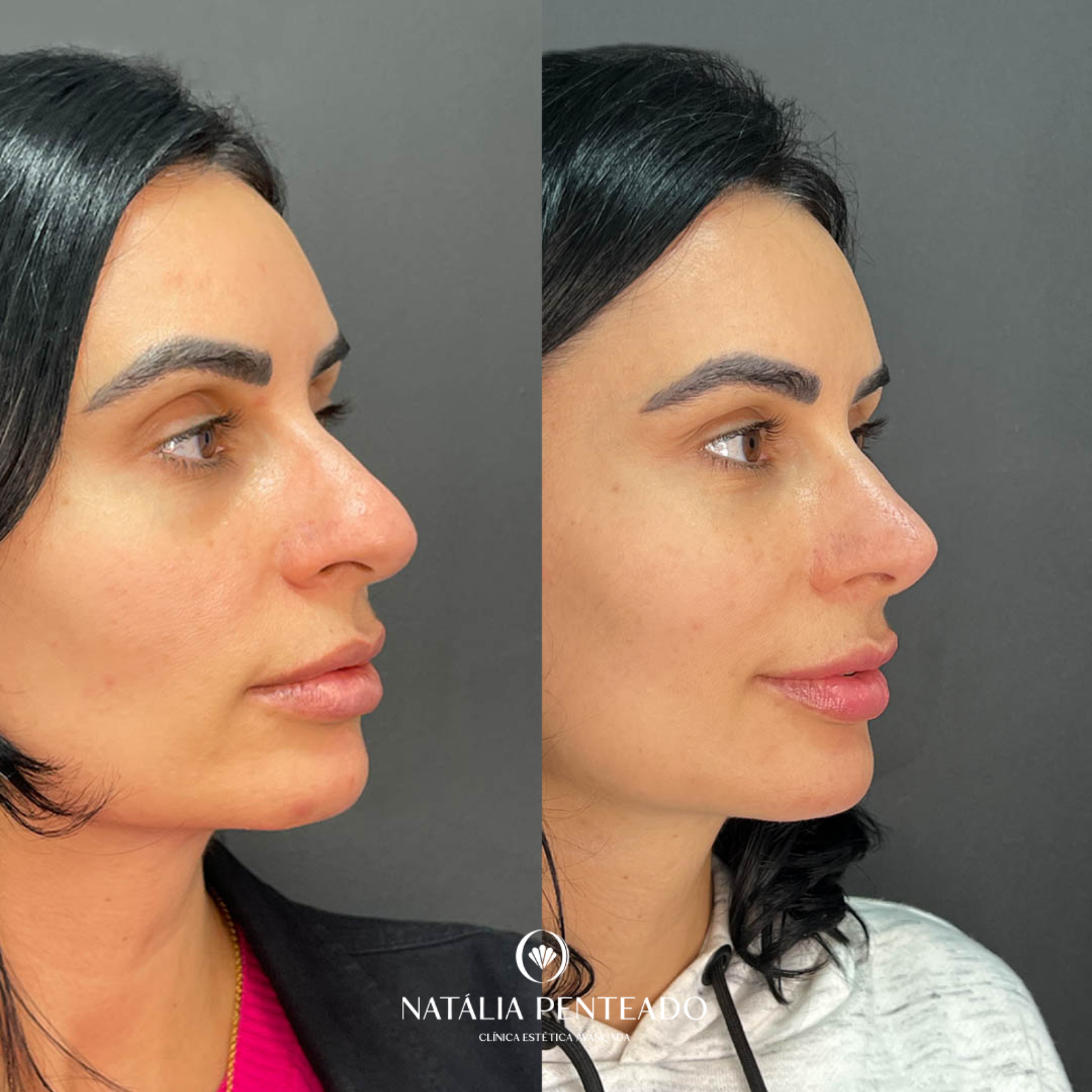 Antes x Depois