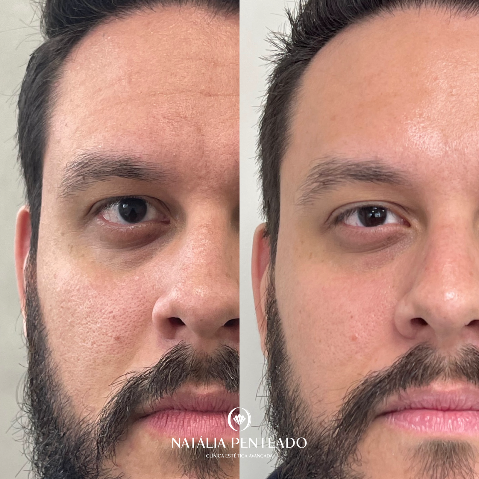 Antes x Depois