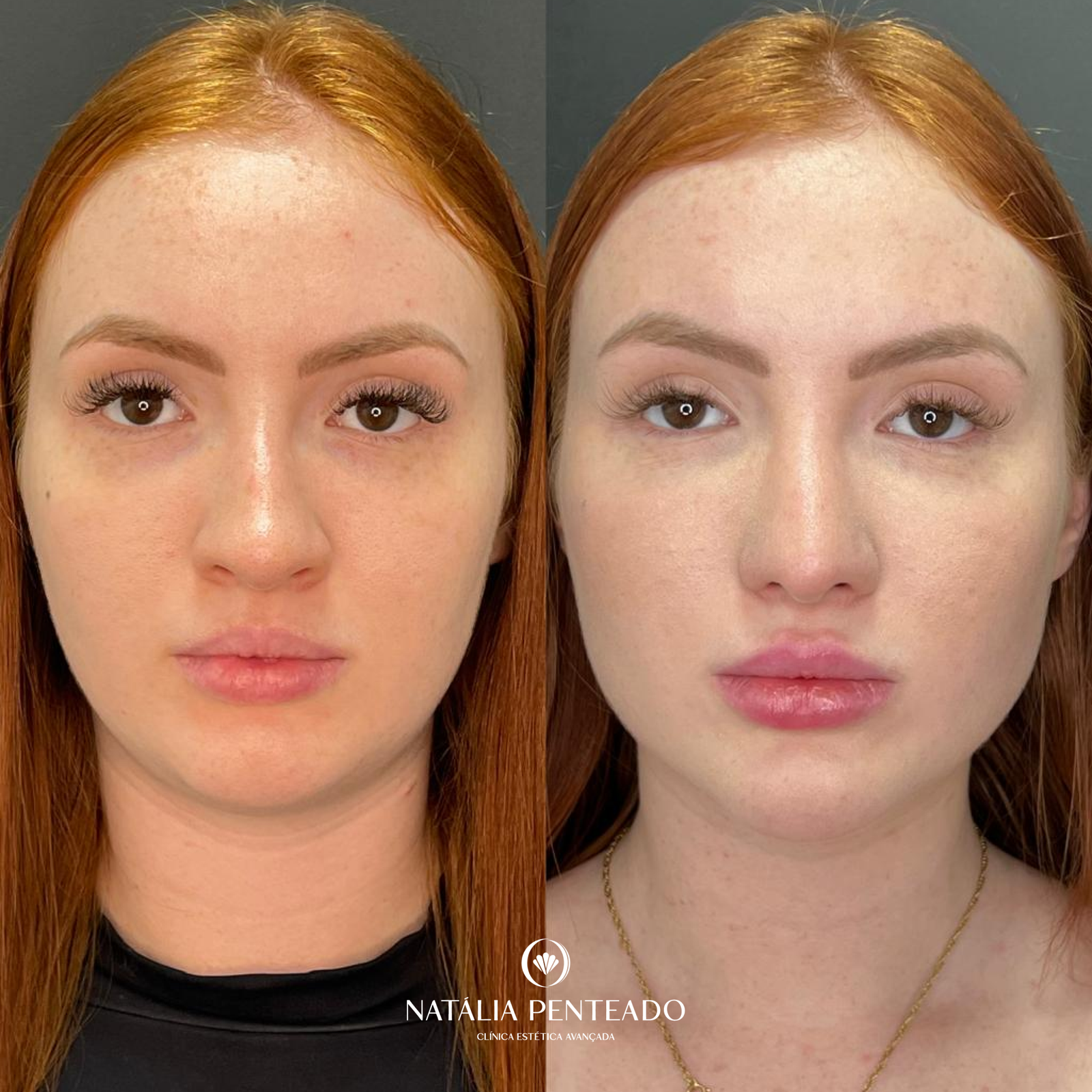 Antes x Depois