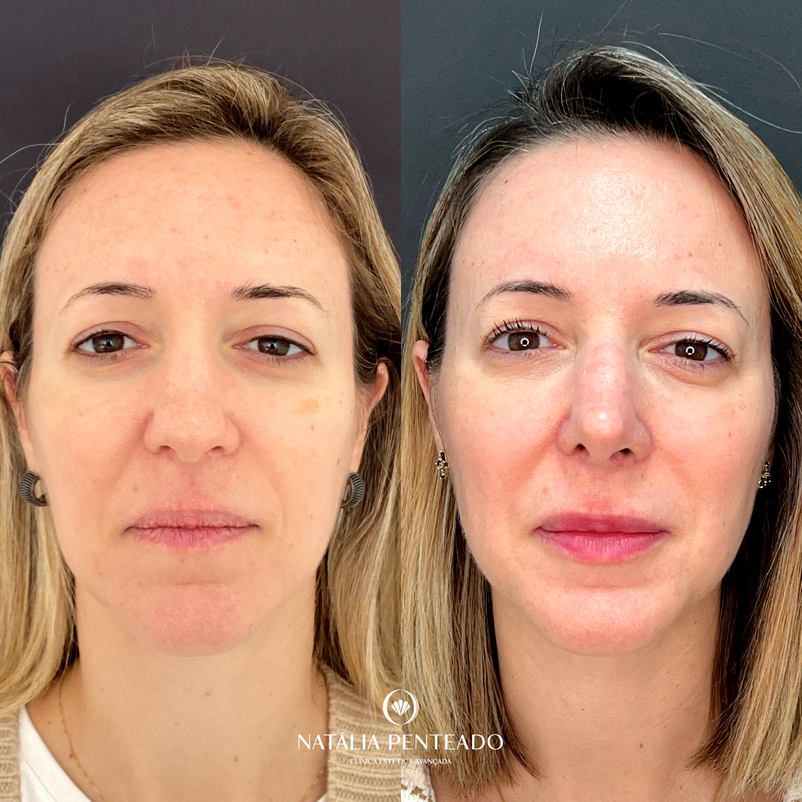 Antes x Depois