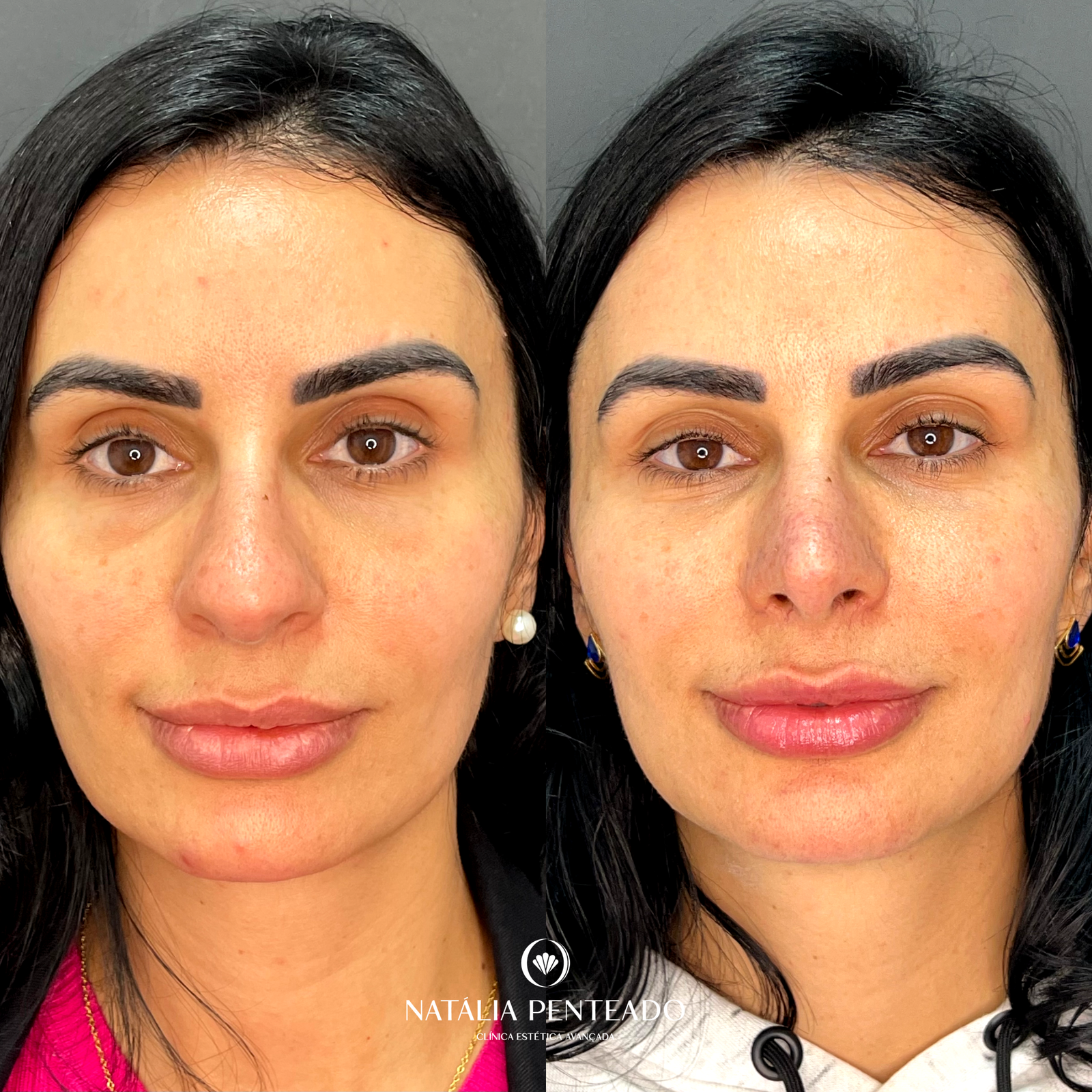 Antes x Depois