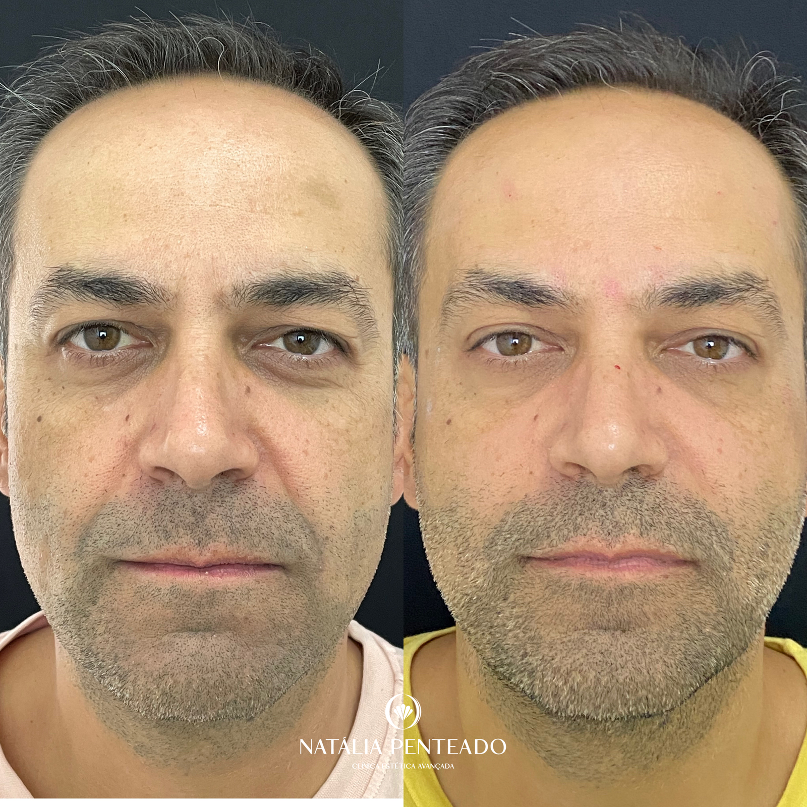 Antes x Depois