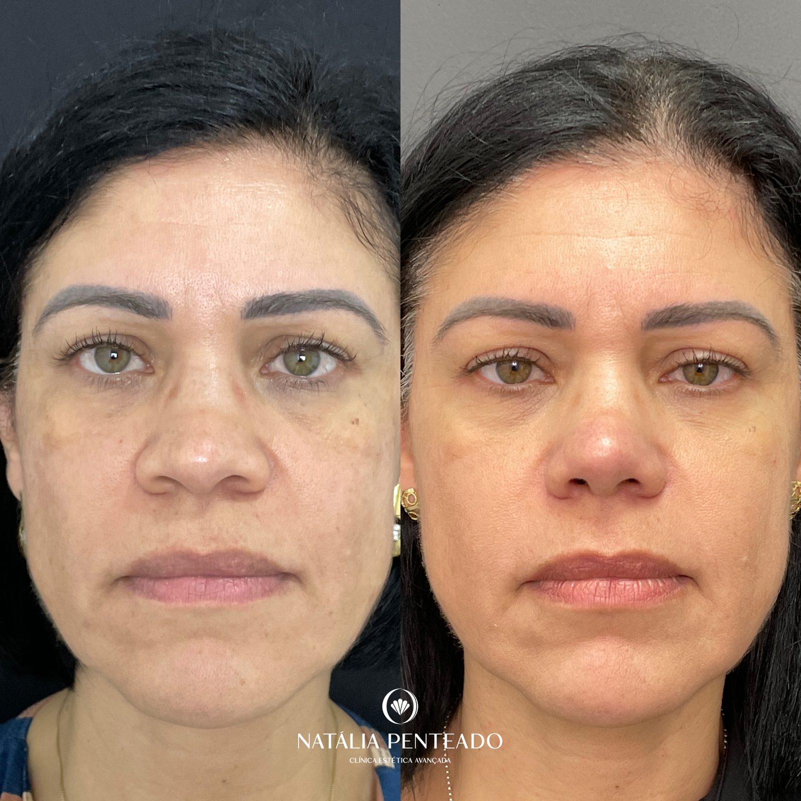 Antes x Depois