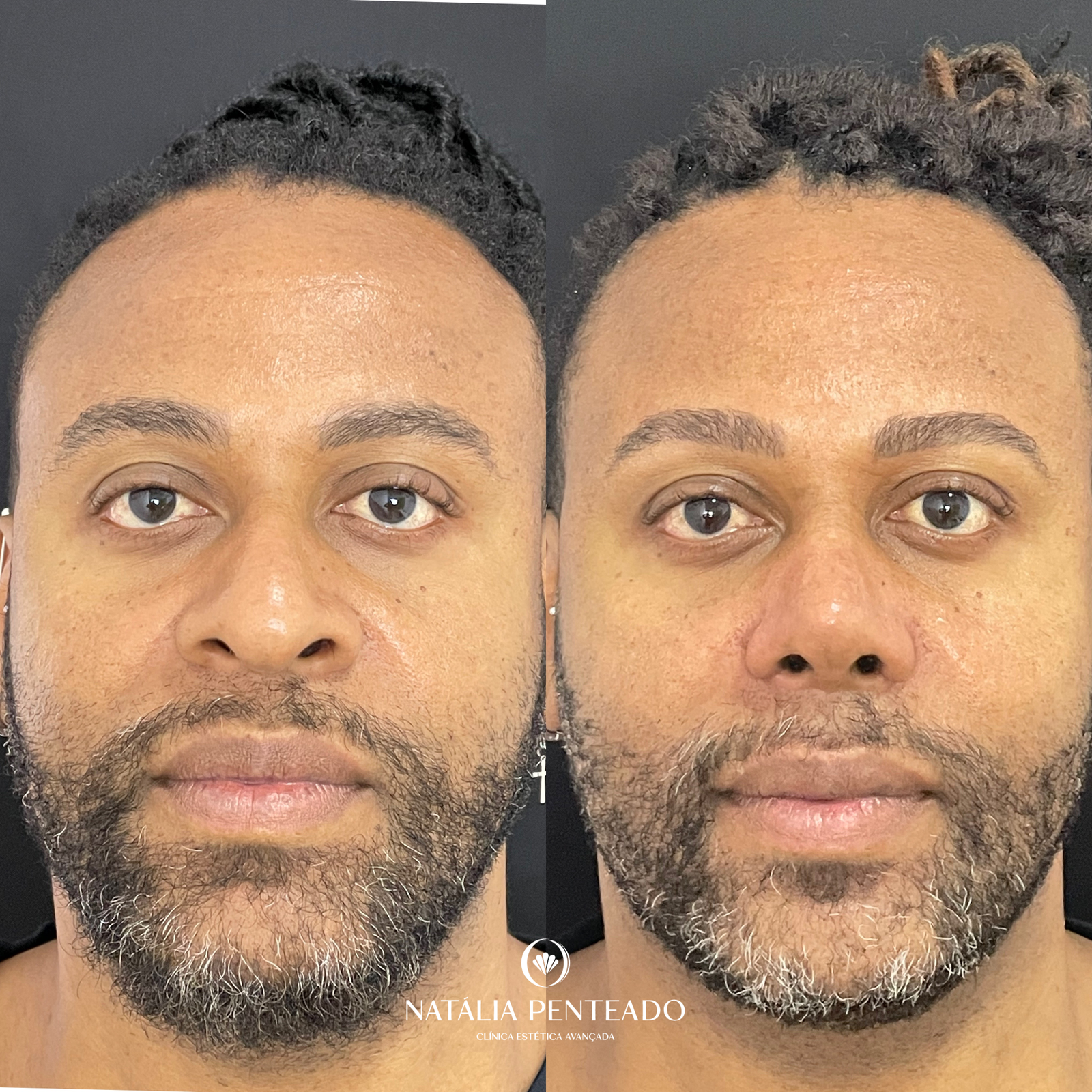 Antes x Depois