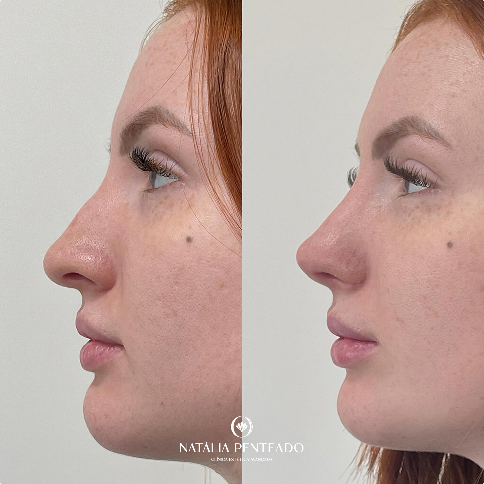Antes x Depois